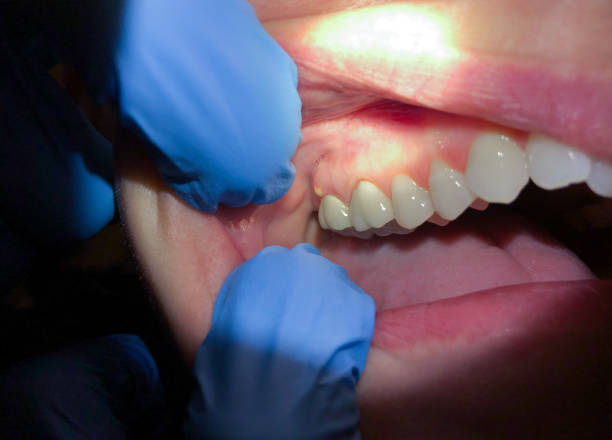 Best Emergency Dental Care for Broken or Chipped Teeth in Sauk Vlage, IL